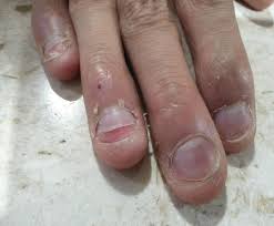 Image result for Onychotillomania feet