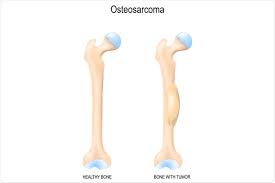 Image result for Osteosarcoma