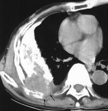 Image result for Pleural Tuberculosis