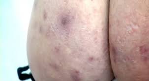 Repeat this dark spots cure to remove black spots on face fast. How To Clear Spots On Your Bum Bottom Spots Easy Guide Manface