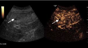 During an external ultrasound of your pelvis, the doctor or radiographer moves a probe over the lower part of your tummy. File Contrast Enhanced Ultrasound Of Ovarian Cancer Metastasis In The Liver Jpg Wikipedia