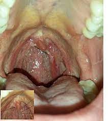 Maybe you would like to learn more about one of these? Papilloma Meaning Marathi Papilloma Meaning In Marathi Human Papilloma Virus Hpv Simtome Diagnostic Tratament