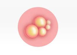 An outbreak of cold sores follows a fairly consistent progression. Cold Sores The 5 Stages Of A Cold Sore Outbreak Orajel