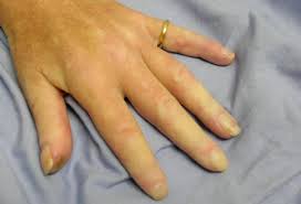 Image result for Systemic Sclerosis
