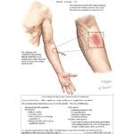 Image result for Pathergy