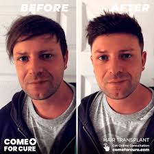 Hair Transplant Reviews