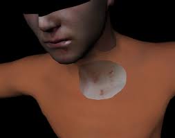 Case study 1. A case with suspicion of strangulation. a) An overview of... 