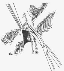 Image result for Blunt Dissection