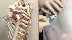 Image result for Subacromial Space Injection