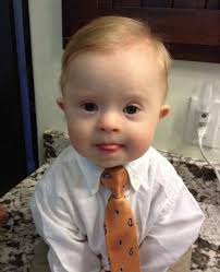This child, with an extra chromosome, is valuable and worthy of life.