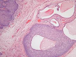 The Vulva And Vagina Chapter 37 Silverberg S Principles And Practice Of Surgical Pathology And Cytopathology This autoimmune skin disease causes blisters on the skin and sometimes lesions in the mouth. the vulva and vagina chapter 37