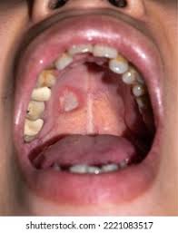 Image result for Canker sores symptoms roof of the mouth