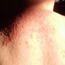 You can be allergic to sunscreen, causing an itchy, red reaction. Allergy Claims Prompt Piz Buin Suncream Chemical Removal Bbc News