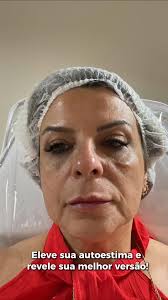 ✨ Transformação em progresso — e já com resultados incríveis! ✨, Nesta  paciente realizamos:, ✔️ Rinomodelação, ✔️ Preenchimento labial (P.  Labial), ✔️ Harmonização de mandíbula e pré-jowls, ✔️ ...