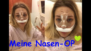Nasenkorrektur Meine Nasen Op Erfahrungen Tipps Vorher Nachher Bilder Youtube