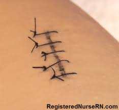 How To Remove Sutures