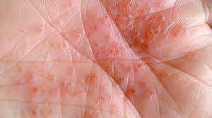 Palm Rash 8 Common Causes And Treatment Options