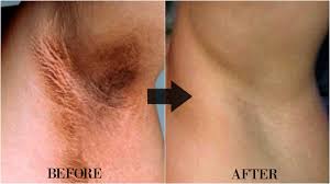 Check spelling or type a new query. How To Lighten Dark Underarms Naturally With Fast Result Omabelletv Youtube