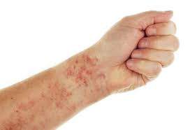 Exploring Allergic Reactions To Medical Implants Vaildaily Com