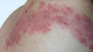 Image result for herpes zoster