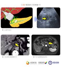 강남세브란스병원에서 췌장 절제술을 받은 145명을 분석한 결과, 췌장암 환자의 당뇨병 유병률은 75.0%로 비췌장암 환자의 38.5%보다 크게. Uniquitous ìžìœ ê²Œì‹œíŒ Free Bulletin Board