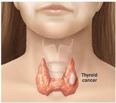 Thyroid cancer typically doesn't cause any signs or symptoms early in the disease. Signs And Symptoms Of Medullary Thyroid Cancer The Headquarters News Latest Unbiased Reliable Pakistan Global And Universal News