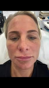 The ultimate FACAIL experience!! Natalie Connelly Ncaesthetics @followers  NC aesthetics PRP PRP is often dubbed the "vampire facelift", a procedure  where ones blood is taken, spun and then vital ...
