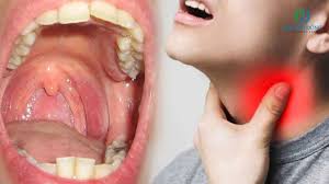 Bệnh phù nề cổ họng: Triệu chứng, nguyên nhân và điều trị