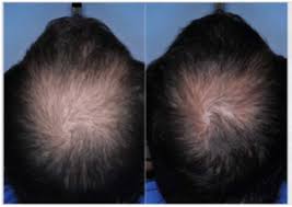 Hair gel with natural ingredients, based on flower essences and essential oils. Follicle Thought Page 20 Hair Growth Treatment News Hair Loss Cure News Treatments For Baldness