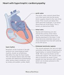 Image result for Cardiomyopathy