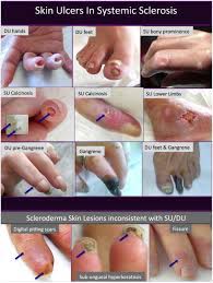 Explore online aesop®'s wide range of products for skin, hair, body and home. Scleroderma Skin Ulcers Definition Classification And Treatment Strategies Our Experience And Review Of The Literature Sciencedirect