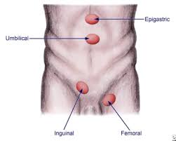 Image result for Inguinal hernia man