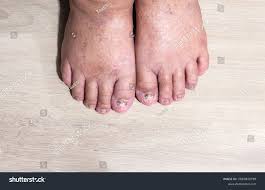 Image result for Koilonychia feet