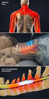 Inyeccion De Esteroides Epidural Cervical Grupo Medico De Ortopedia De La Costa Central