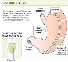 What I Had With Images Sleeve Surgery Gastric Sleeve Surgery Gastric Sleeve