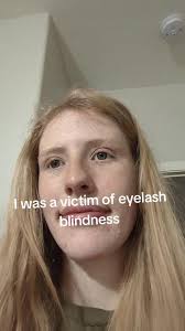 Eyelash Blindness: My 2020 Experience