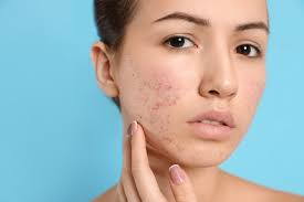 What is acne skin
