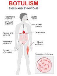 An infectious bacterial species clostridium botulinum release this toxin. Botulism Outbreak Raises Public Health Concerns In California Food Safety News