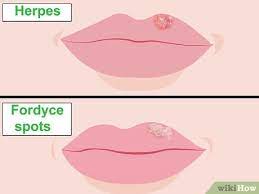 Slightly it makes your lips look odd. How To Get Rid Of Fordyce Spots 12 Steps With Pictures