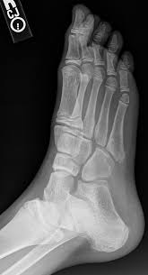 Image result for Foot XRay