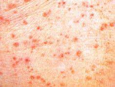 Apple cider vinegar for mouth infection. 8 Skin Health Ideas Skin Health Grover Disease Health