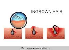 If you remove a bunch of hair before you shave, it reduces the work the razor has to perform, which reduces your risk of cuts and razor burn. How Long Does An Ingrown Hair Last Cases Symptoms Treatments