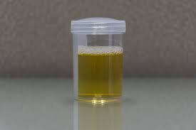 Jika kencing dengan urine berbusa terkait dehidrasi, cara mengatasinya yakni minum banyak air putih dan cairan lain sampai urine berwarna bening atau nyaris transparan. Penyebab Air Kencing Berbusa Dan Pengobatannya Honestdocs