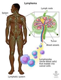 Medical illustration of the lymphatic system and lymphoma in lymph nodes