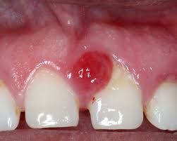 Image result for granuloma gum disease