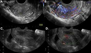 (before or after menopause) hormone therapy is not used for early stage uterine cancer, but it may be offered for advanced there is no single cause of uterine cancer, but some factors increase the risk of developing it. Abnormal Uterine Bleeding And The Risk Of Endometrial Cancer Can Subendometrial Vascular Ultrasound Be Of Help To Discriminate Cancer From Adenomyosis American Journal Of Obstetrics Gynecology