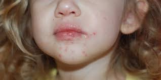 Una volta comparso l'esantema la malattia non è più contagiosa per cui il bambino. Quinta Malattia I Sintomi E Il Contagio Roba Da Donne