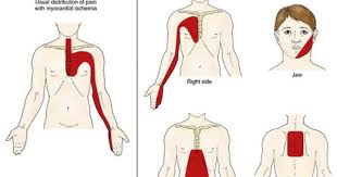 Pin On Upper Back Pain