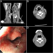 If you do, intravenous (iv) antibiotics during labor can save your baby's life. Necrotizing Fasciitis Of The Neck With Pharyngeal Fistula An Unusual Case Presentation International Journal Of Infectious Diseases
