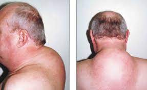 People will sometimes notice a fatty pad behind their neck, around the hump. Buffalo Hump Causes Diagnosis Buffalo Hump Treatment